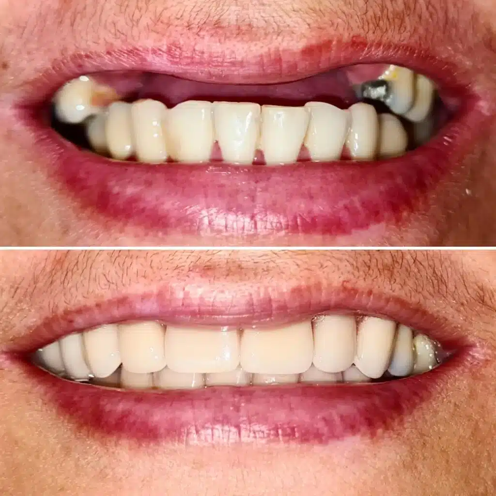 Caso clínico de implante dentário - antes e depois