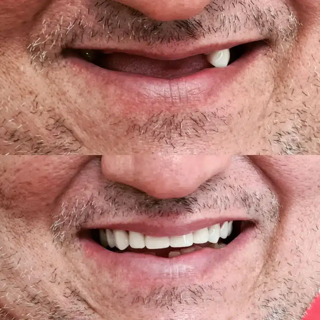 Caso clínico de implante dentário - resultado