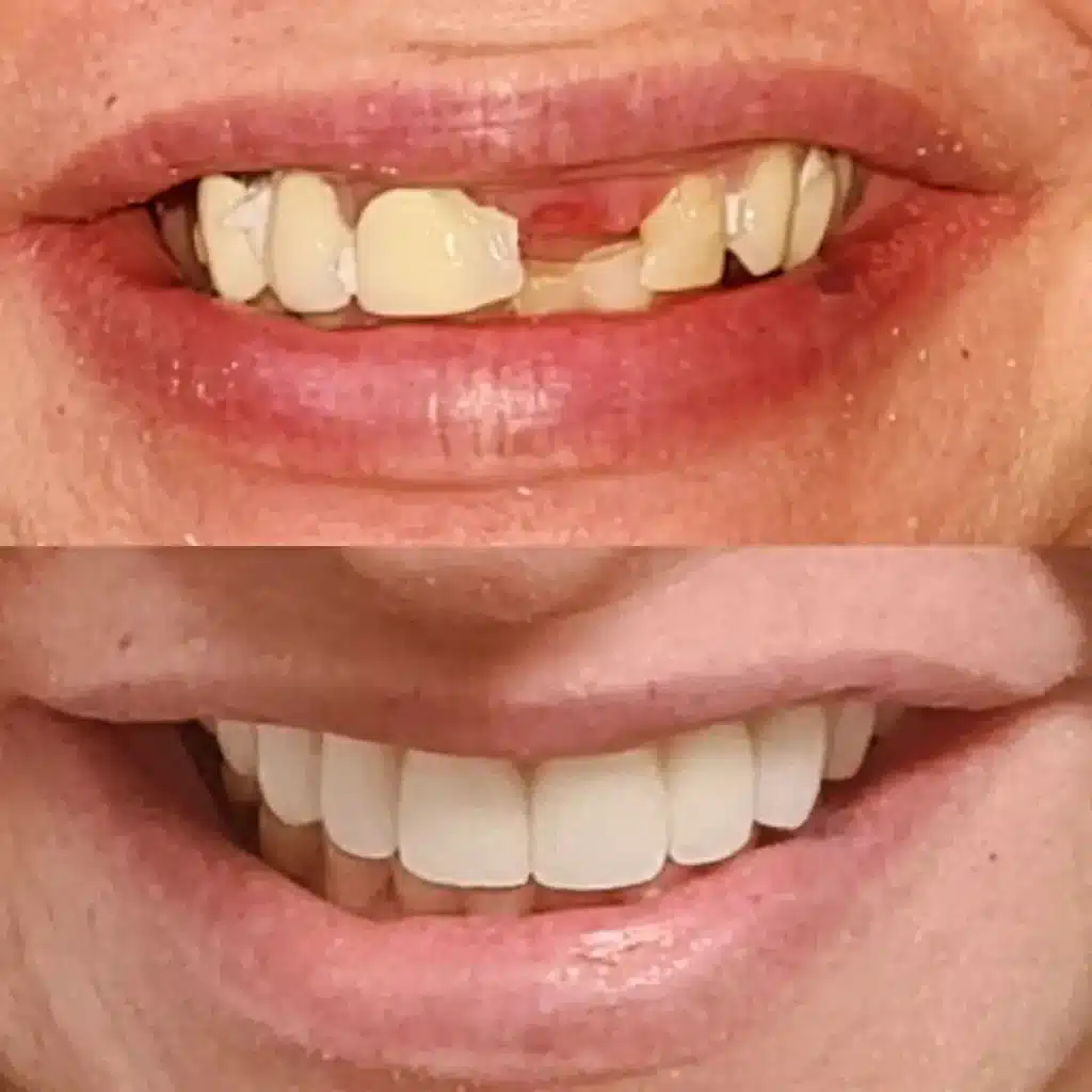 implante dentario